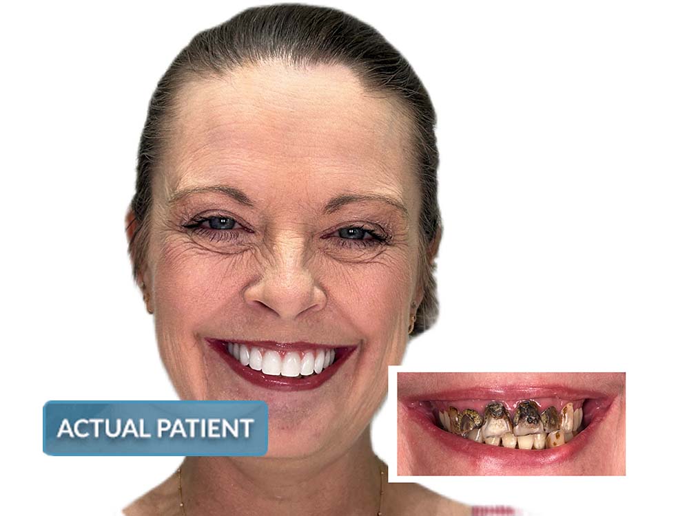 Invisalign Smile Gallery