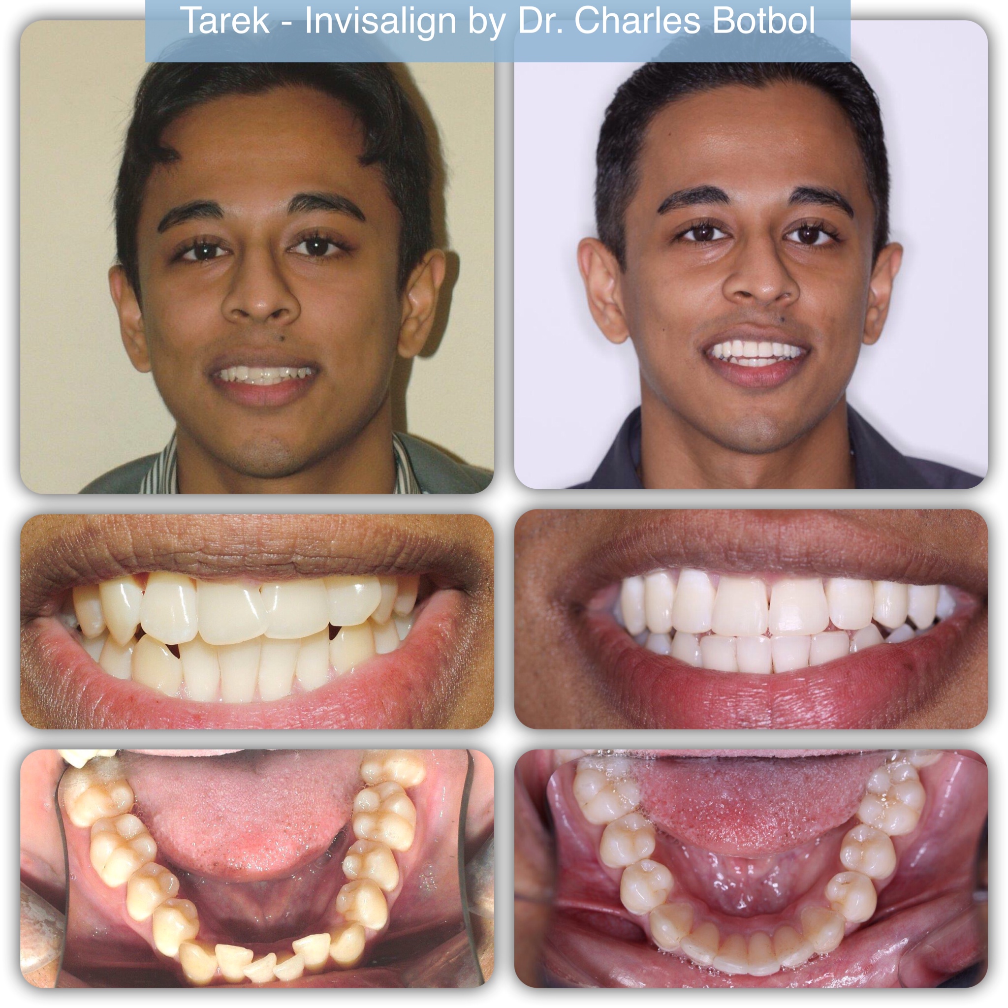 Invisalign Braces, Invisalign Clear Aligners & Treatment, Mississauga - Dr.  Pinto